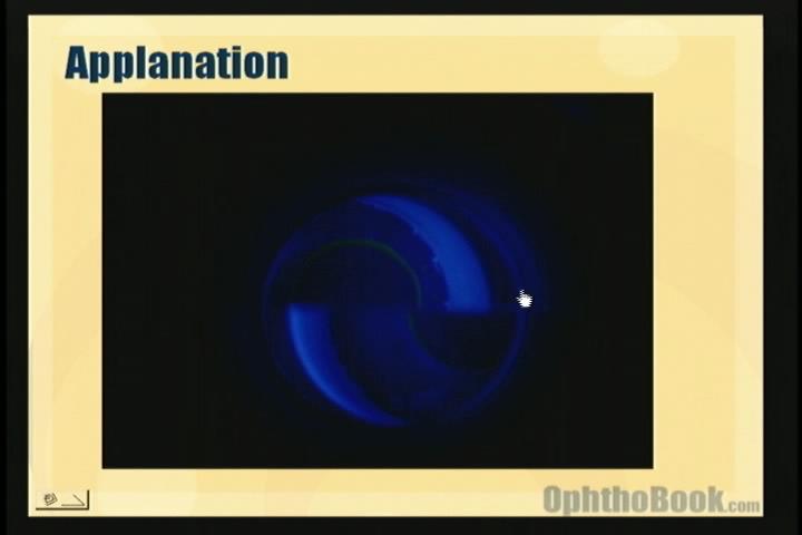 video-glaucoma-applanation.jpg