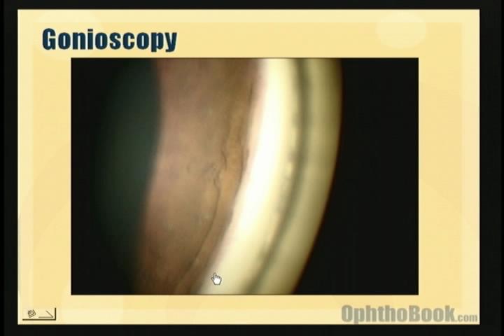 video-glaucoma-gonioscopy2.jpg