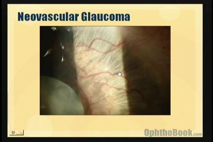 video-glaucoma-neo.jpg
