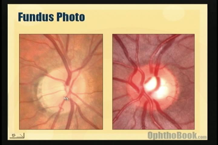 video-glaucoma-opticnerve.jpg