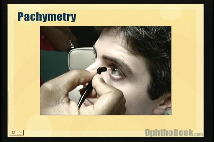 video-glaucoma-pacymetry.jpg