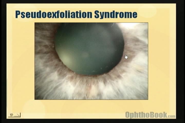 video-glaucoma-pseudoexfoliation.jpg