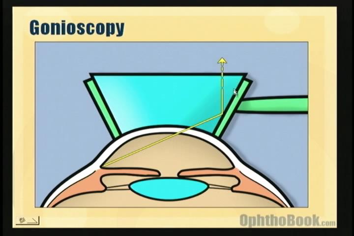 video-glaucoma-totalinternalreflection.jpg
