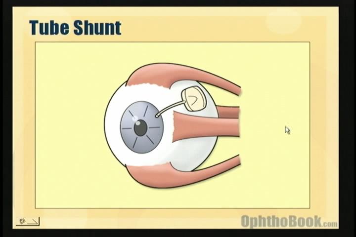 video-glaucoma-tubeshunt.jpg