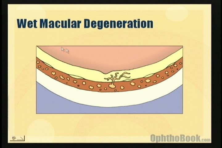 video-retina-armd.jpg