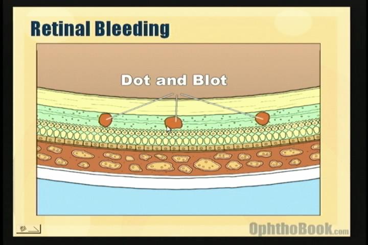 dot blot hemorrhages