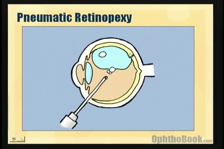 video-retina-pneumatic.jpg