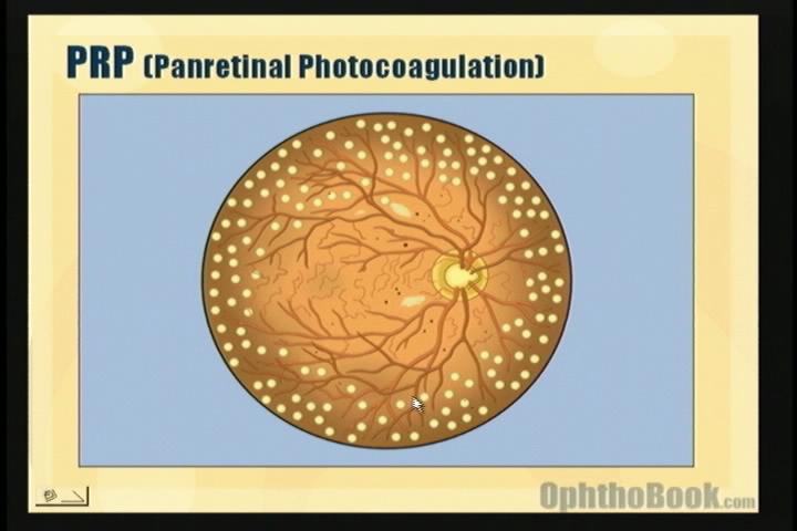 video-retina-prp.jpg