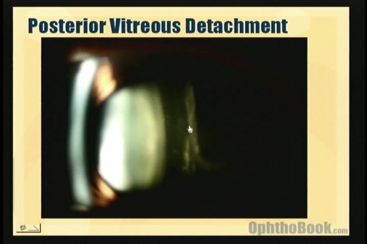 video-retina-pvd.jpg