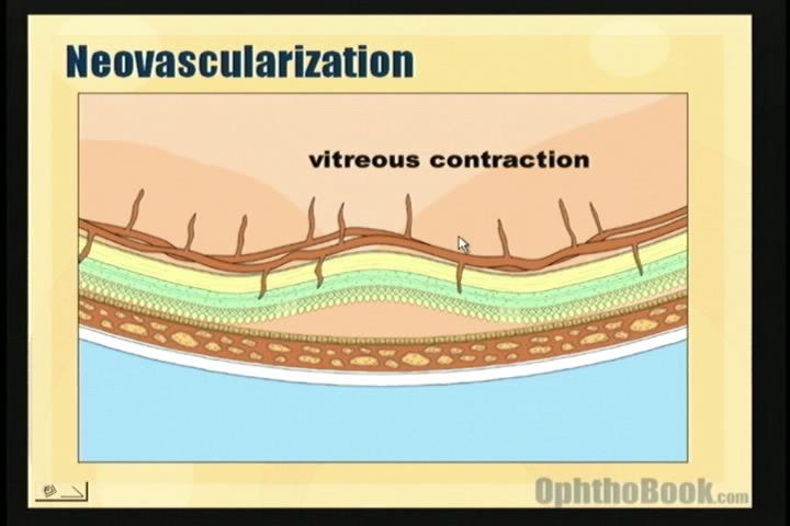 video-retina-traction.jpg