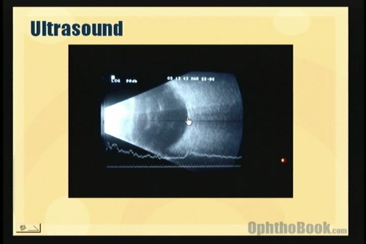 video-retina-ultrasound.jpg
