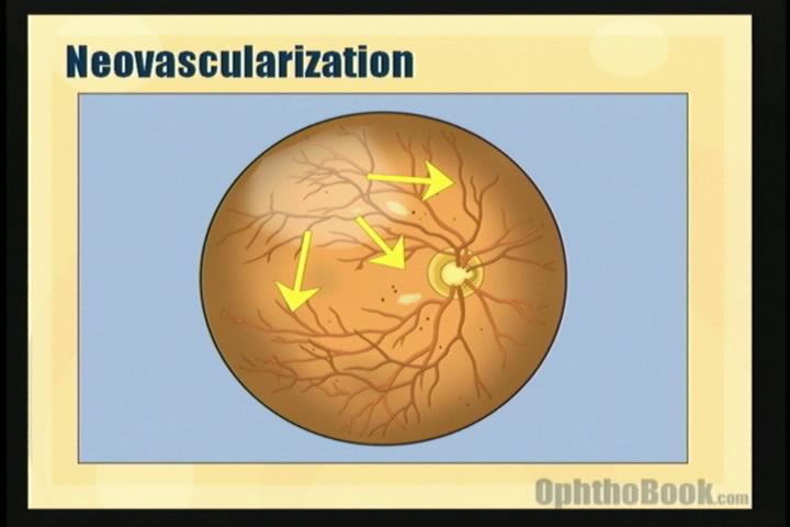 video-retina-vegf.jpg