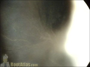 Amiodarone cornea